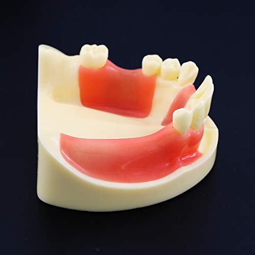 השתלת שיניים תרגול שיניים מודל שיניים הדגמה של שיקום שיקום יתר של לימוד מלמדת חניכיים נשלפות לסת נמוכה יותר