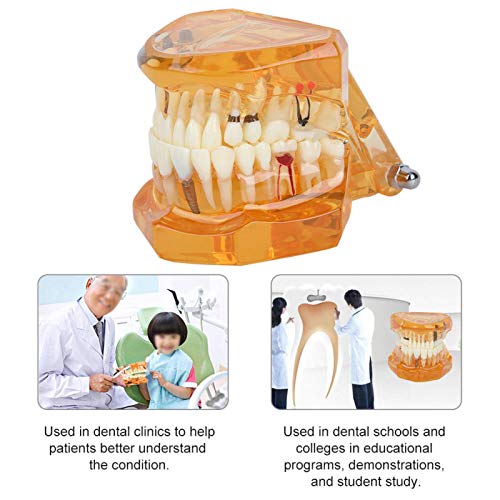 דגם שיניים סטנדרטי מודל-דנטלי לחינוך מטופלים, דגם שיניים סטנדרטיות דגם שיניים דגם אוראלי דגם מחלת שיניים נשלפת
