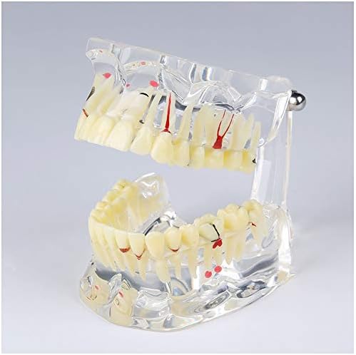 Kh66zky השתלת שיניים עששת עששת תצוגה מודל פתולוגיות למבוגרים שקופים מודל שיניים שן חסרה לרופאי שיניים סטודנטים